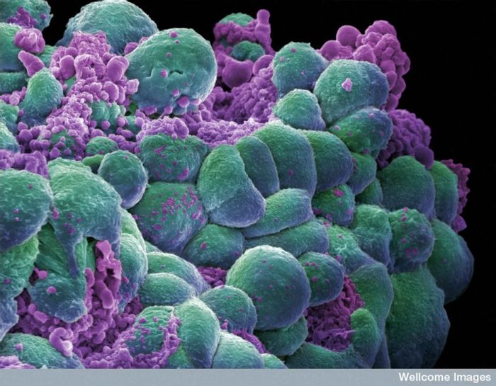 In this image, cancerous mammary cells have begun a process known as apoptosis, or programmed cell death. In this image, cancerous mammary cells have begun a process known as apoptosis, or programmed cell death.