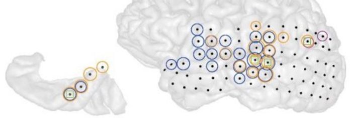 3-D image of the left hemisphere of a patient with tinnitus (right). Black dots indicate all the sites recorded from. Colored circles indicate electrodes at which the strength of ongoing brain activity correlated with the current strength of tinnitus perceived by the patient. Different colors indicate different frequencies of brain activity (blue = low, magenta = middle, orange = high). 3-D image of the left hemisphere of a patient with tinnitus (right). Black dots indicate all the sites recorded from. Colored circles indicate electrodes at which the strength of ongoing brain activity correlated with the current strength of tinnitus perceived by the patient. Different colors indicate different frequencies of brain activity (blue = low, magenta = middle, orange = high).