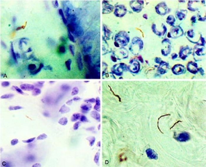 Microscopic images of Borrelia burgdorferi Microscopic images of Borrelia burgdorferi