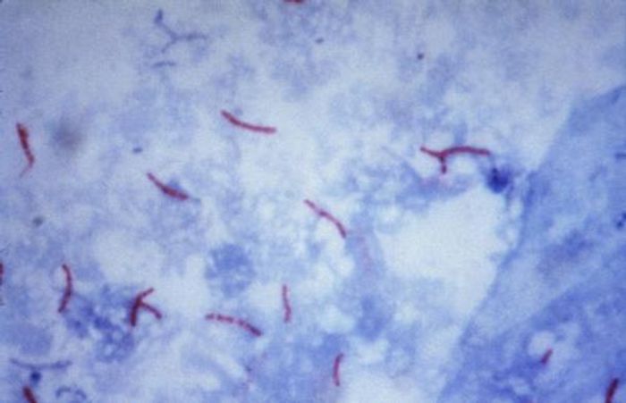 This photomicrograph reveals Mycobacterium tuberculosis bacteria using acid-fast Ziehl-Neelsen stain; Magnified 1000 X. The acid-fast stains depend on the ability of mycobacteria to retain dye when treated with mineral acid or an acid-alcohol solution such as the Ziehl-Neelsen, or the Kinyoun stains that are carbolfuchsin methods specific for M. tuberculosis. This photomicrograph reveals Mycobacterium tuberculosis bacteria using acid-fast Ziehl-Neelsen stain; Magnified 1000 X. The acid-fast stains depend on the ability of mycobacteria to retain dye when treated with mineral acid or an acid-alcohol solution such as the Ziehl-Neelsen, or the Kinyoun stains that are carbolfuchsin methods specific for M. tuberculosis.