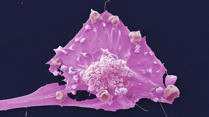 Researchers look for answers to metastasis by using rare tumor cells from the Brisbane Breast Bank. Researchers look for answers to metastasis by using rare tumor cells from the Brisbane Breast Bank.