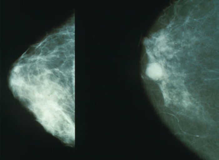 A few years ago, it was reported that breast cancer patients with a high number of immune cells called neutrophils in their blood are at increased risk of developing metastases. A few years ago, it was reported that breast cancer patients with a high number of immune cells called neutrophils in their blood are at increased risk of developing metastases.