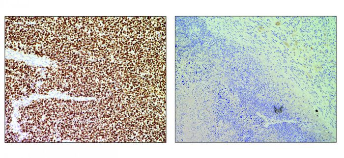 An untreated tumour on the left and on the right, a CRISPR-treated tumor. Cells are stained with a cell proliferation marker (Ki67); brown shows cells in the untreated tumour proliferating, but not in the CRISPR-treated tumour / Credit: CNIO