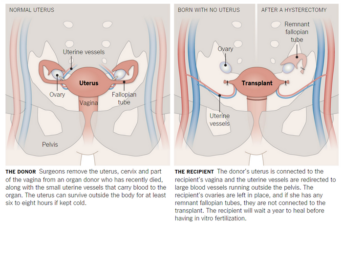 Uterus Transplant