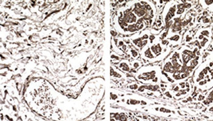 Samples from non-metastatic (left) and metastatic breast cancer (right) cells showing enhanced expression of a specific gene in metastatic tumors because those cells have increased levels of a tRNA called GluUUC.