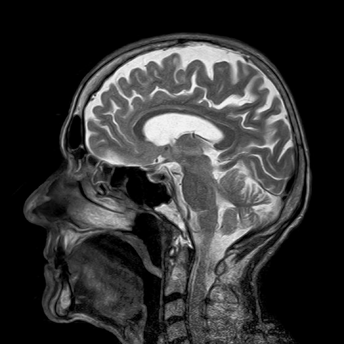 Safer way to administer brain MRIs