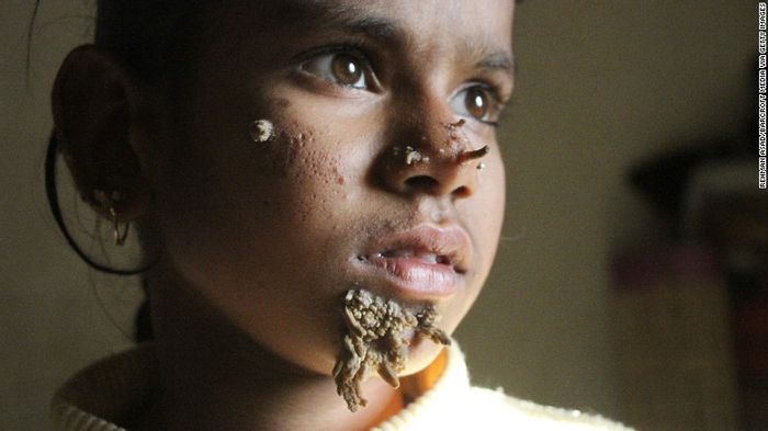 Diagnosed: First Female Case of 'Tree Man Syndrome' | Clinical And ...