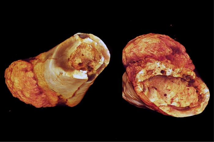 Million year old fossilized cancer in metatarsals | Image: Edward Odes (Wits)