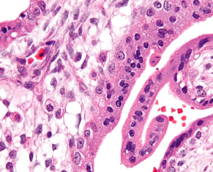 Micrograph showing chorionic villi of placenta with Hofbauer cells