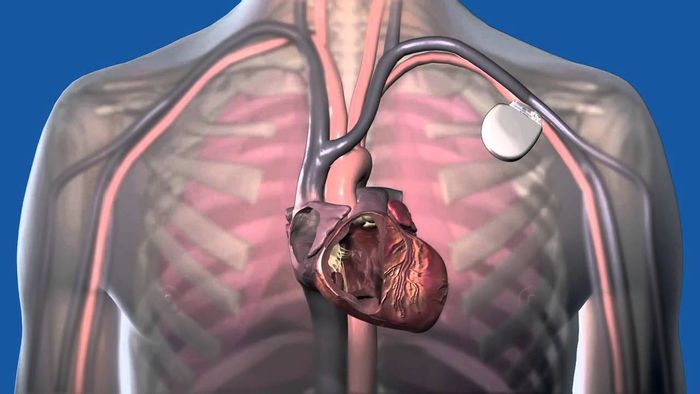 Source: MedtronicEurope
